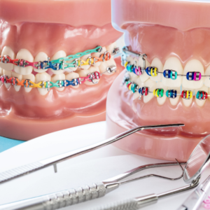 Zabiegi po demontażu aparatu ortodontycznego - usuwanie kleju i attachments, ICON, cyfrowe wybielanie - dofinsowanie BUR 2026