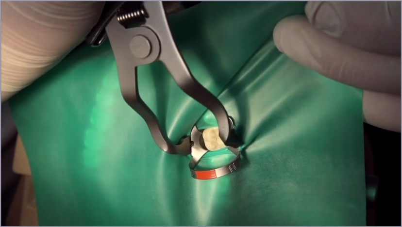 Asysta endodontyczna. Praca z koferdamem - obrazek 2